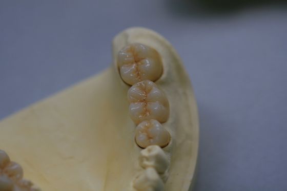 Corona dental del laboratorio de circonio del óxido de la circona dental de la porcelana con de cerámica