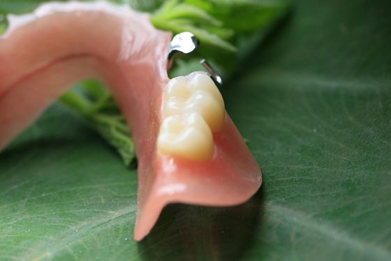 Dentadura parcial de acrílico desprendible parcial