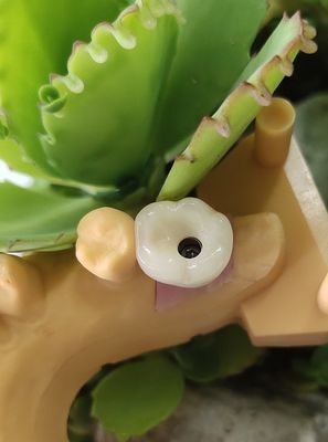 Los implantes dentales cementados NOBEL BIOCARE de la solución coronan