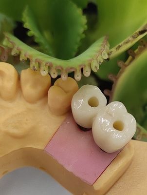 Los implantes dentales cementados NOBEL BIOCARE de la solución coronan