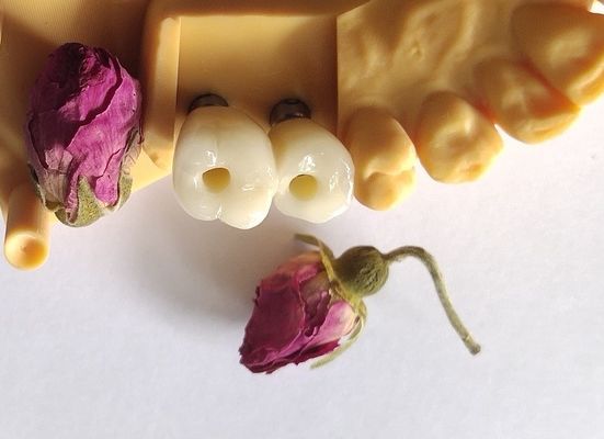 Puentes cementados de las coronas de los implantes