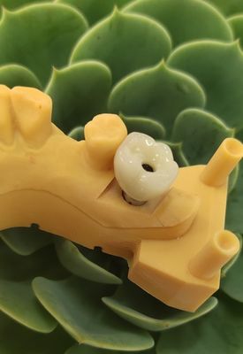 Puentes cementados de las coronas de los implantes