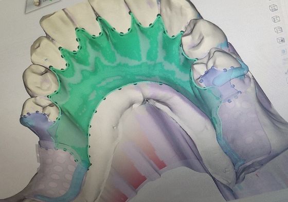 3D desprendible imprimió el marco parcial del metal de la dentadura