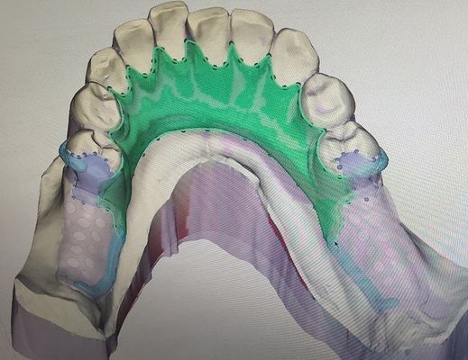 3D desprendible imprimió el marco parcial del metal de la dentadura