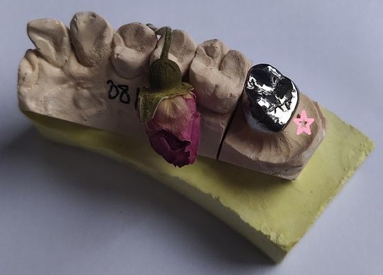 El metal bajo del molde lleno alea la corona dental