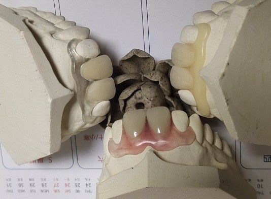 Dentadura invisible flexible parcial para los dientes anteriores