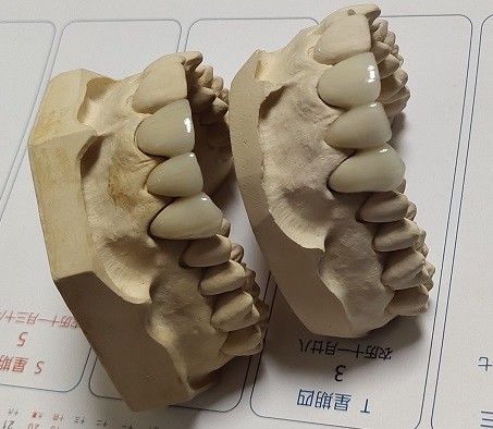 Corona de la leva PFM de la porcelana cad