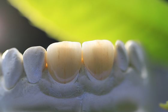 corona dental del laboratorio del marco PFM de la impresión 3D para la odontología