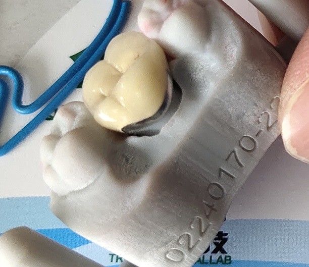 Porcelana dental de la corona de la leva PFM del producto cad del laboratorio fundida al metal