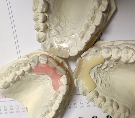 Dentadura invisible libre del metal de la resina para el paciente alérgico